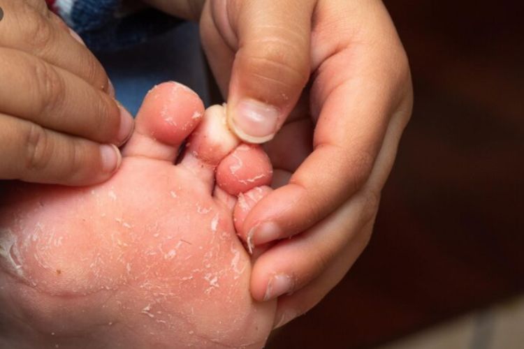 Foot Corn Causes And Treatment